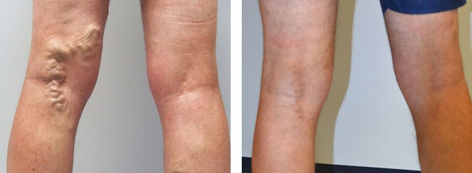 Снимка преди и след използване на Veniselle, опитът от използването на крем