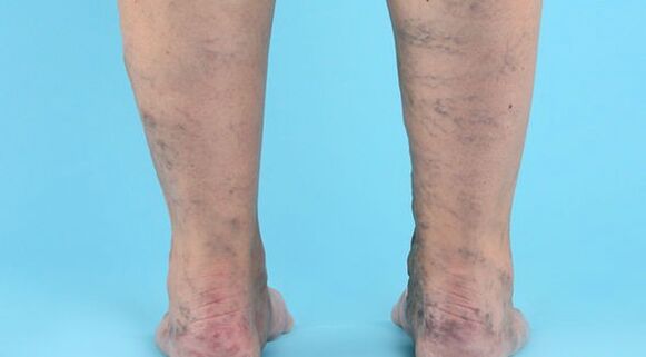 Варикозно заболяване