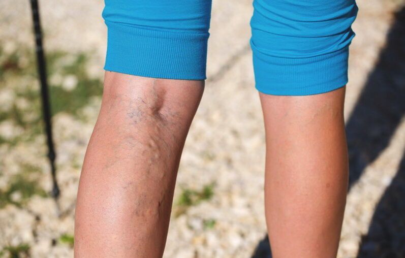 Увреждане на долните крайници