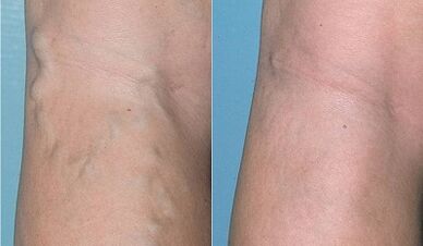 Как да се лекуват разширени вени по краката