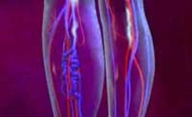 Причини и лечение на разширени вени