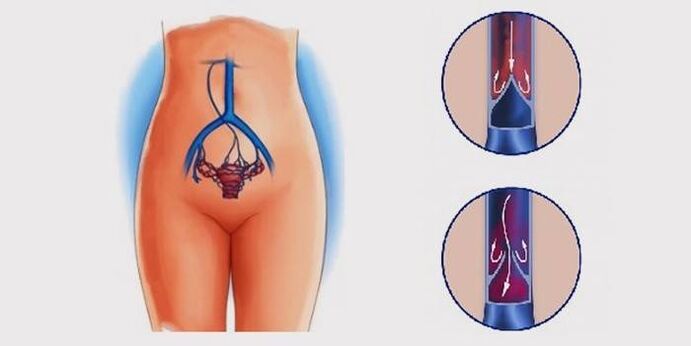 Разширени вени на малкия таз