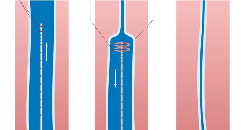 лазерно лечение на разширени вени на краката