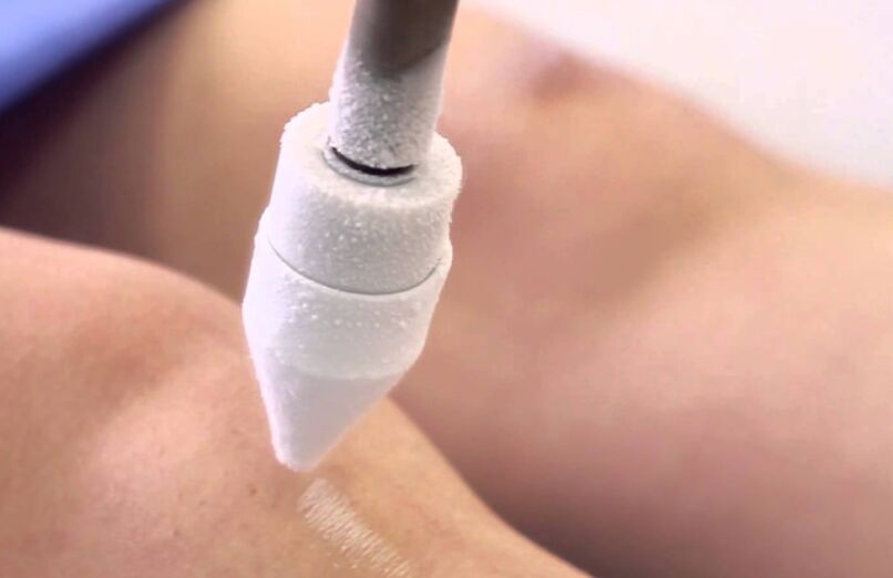 лечение на разширени вени на краката с криотерапия