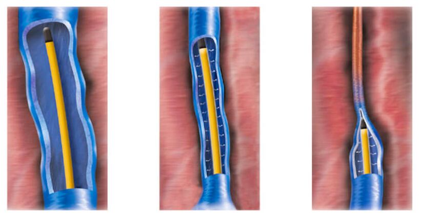 радиочестотна аблация като метод за лечение на разширени вени